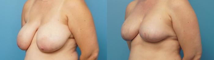 Before & After Breast Reconstruction with Implants Case 309 View #2 View in North Shore, IL