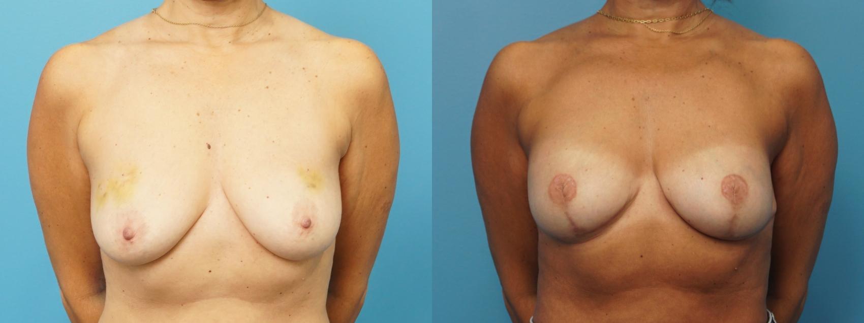 Before & After Breast Reconstruction with Implants Case 311 View #1 View in Northbrook, IL