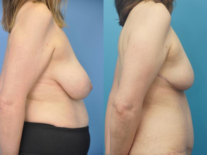 Before & After Breast Reconstruction with Implants Case 312 View #1 View in North Shore, IL