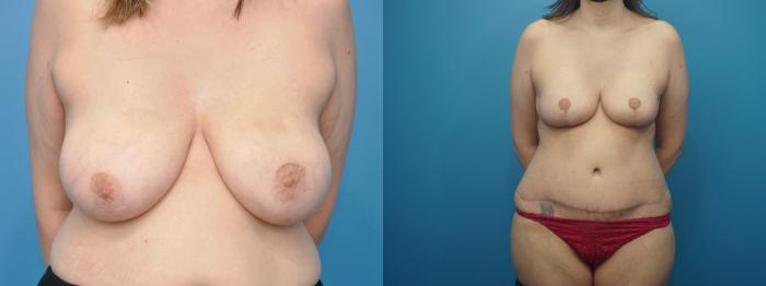 Before & After Breast Reconstruction with Implants Case 312 View #2 View in North Shore, IL