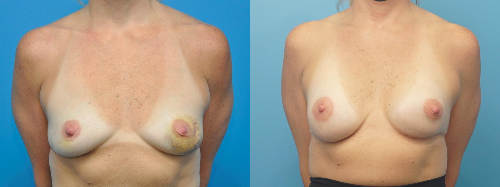 Before & After Breast Reconstruction with Implants Case 313 View #1 View in Northbrook, IL