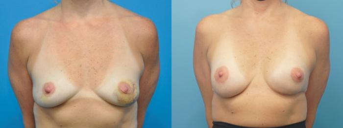 Before & After Breast Reconstruction Case 313 View #1 View in Northbrook, IL