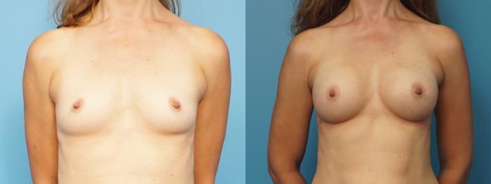 Before & After Breast Reconstruction with Implants Case 314 View #1 View in North Shore, IL