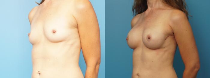 Before & After Breast Reconstruction with Implants Case 314 View #2 View in North Shore, IL