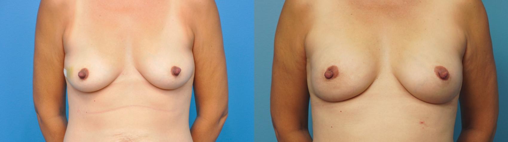 Before & After Breast Reconstruction with Implants Case 315 View #1 View in North Shore, IL