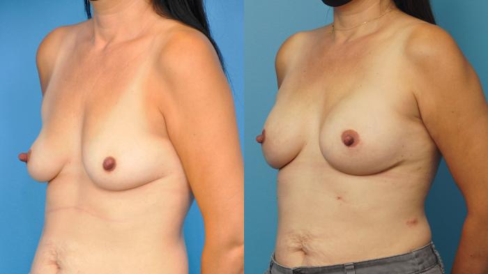 Before & After Breast Reconstruction with Implants Case 315 View #2 View in Northbrook, IL
