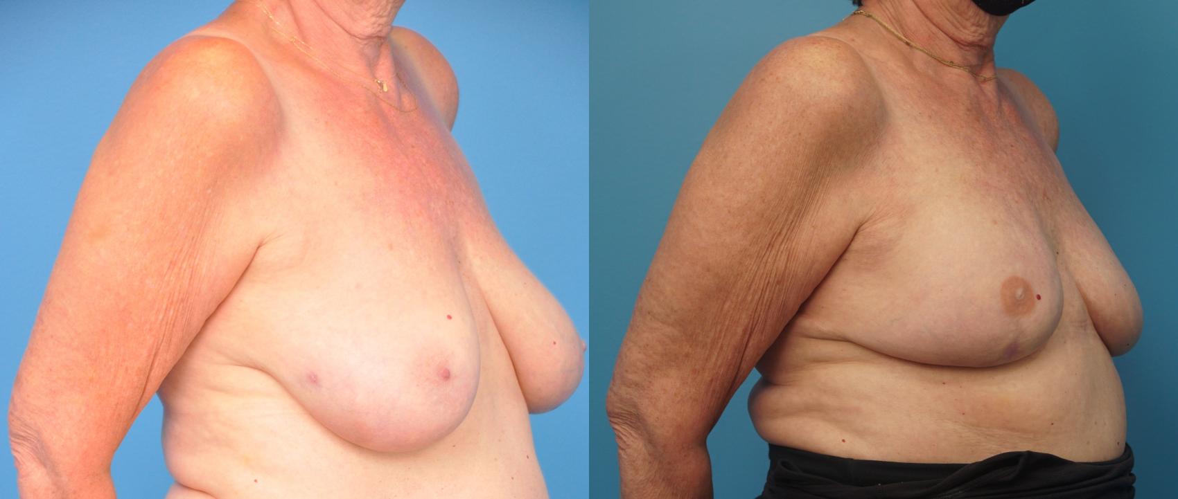 Before & After Breast Reconstruction with Implants Case 324 Right Oblique View in North Shore, IL