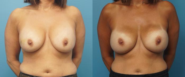 Before & After Breast Reconstruction with Implants Case 330 Front View in North Shore, IL