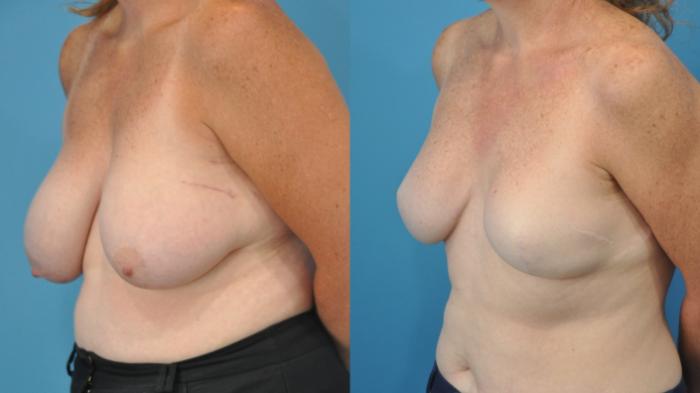 Before & After Breast Reconstruction with Implants Case 335 Left Oblique View in North Shore, IL