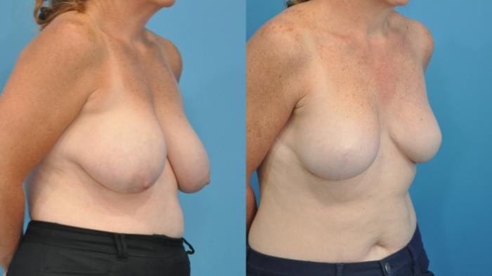 Before & After Breast Reconstruction with Implants Case 335 Right Oblique View in North Shore, IL