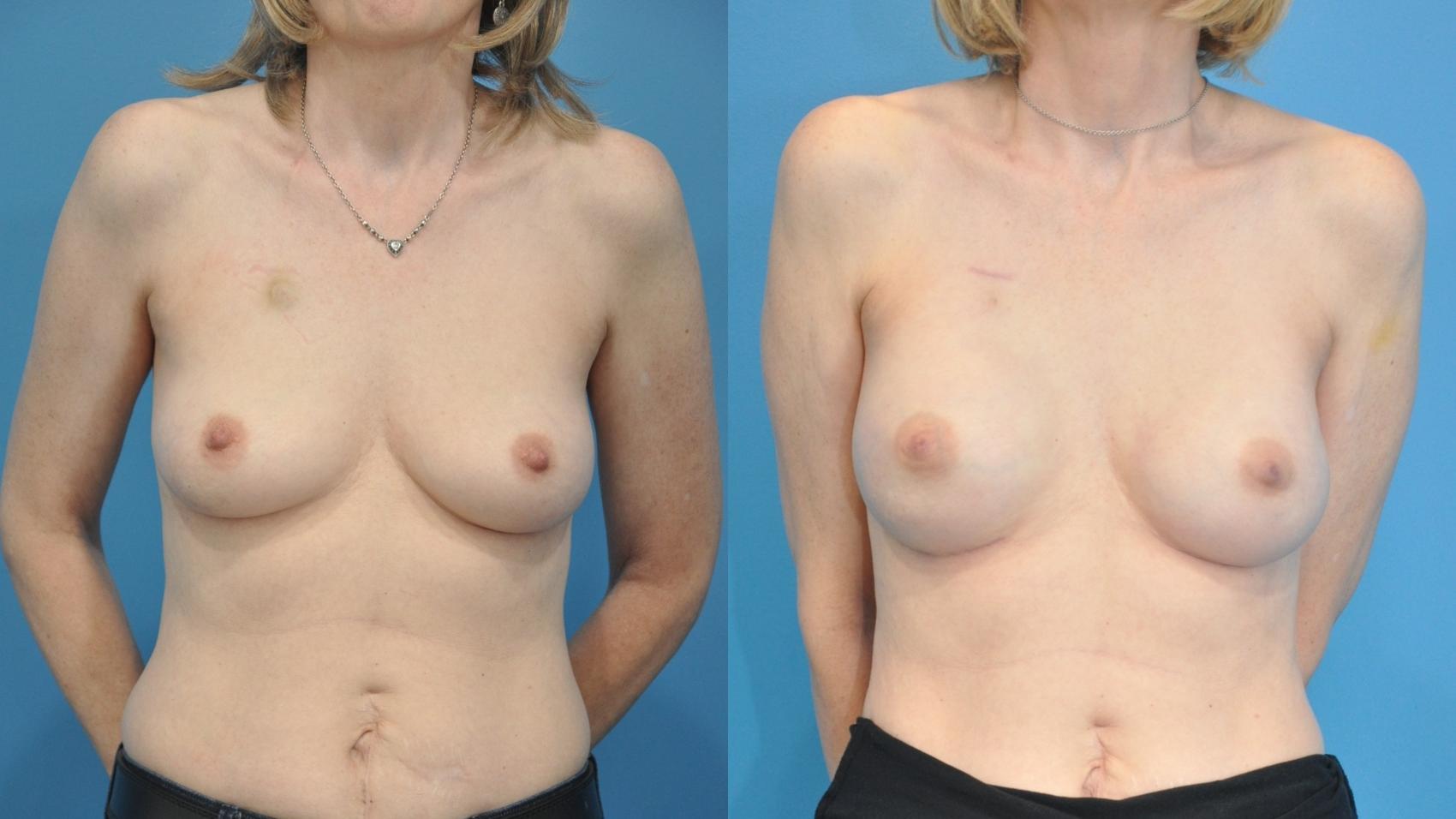 Before & After Breast Reconstruction with Implants Case 341 Front View in North Shore, IL