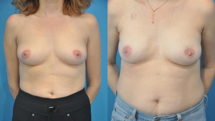 Before & After Breast Reconstruction with Implants Case 344 Front View in Northbrook, IL