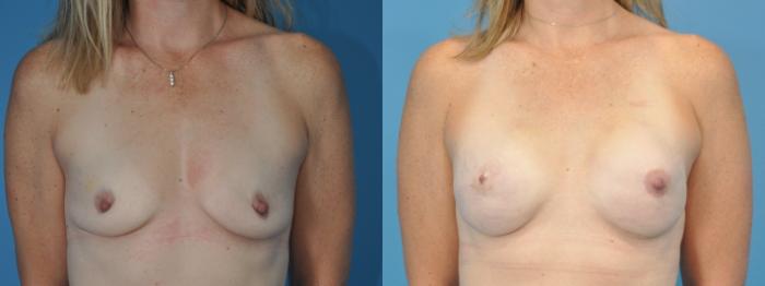 Before & After Breast Reconstruction with Implants Case 349 Front View in Northbrook, IL