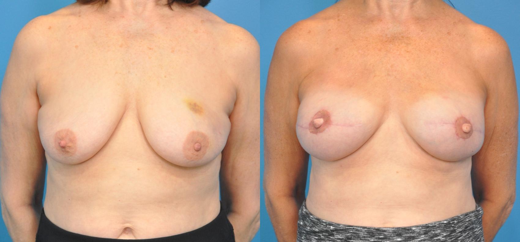 Before & After Breast Reconstruction with Implants Case 35 View #1 View in North Shore, IL