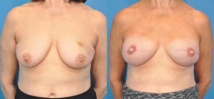 Before & After Breast Reconstruction with Implants Case 35 View #1 View in North Shore, IL