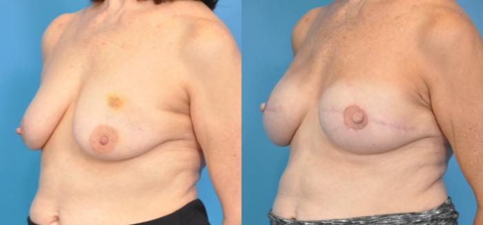 Before & After Breast Reconstruction with Implants Case 35 View #2 View in North Shore, IL