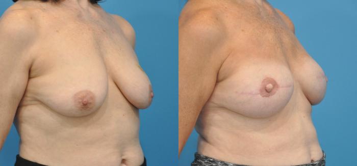 Before & After Breast Reconstruction with Implants Case 35 View #3 View in North Shore, IL