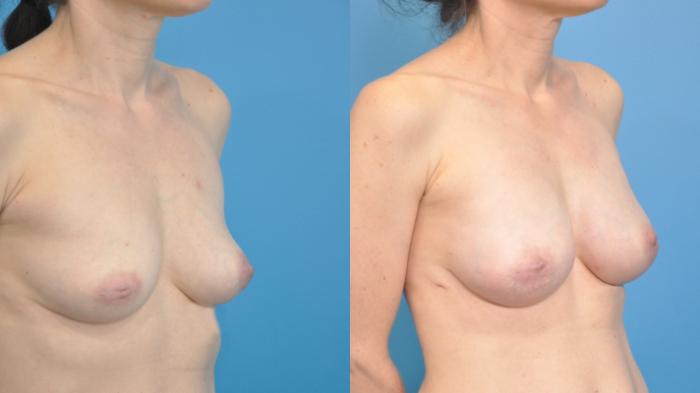 Before & After Breast Reconstruction with Implants Case 350 Right Oblique View in North Shore, IL