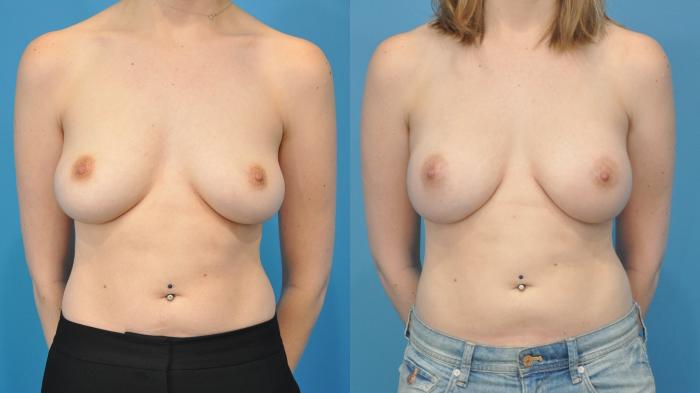 Before & After Breast Reconstruction with Implants Case 356 Front View in North Shore, IL