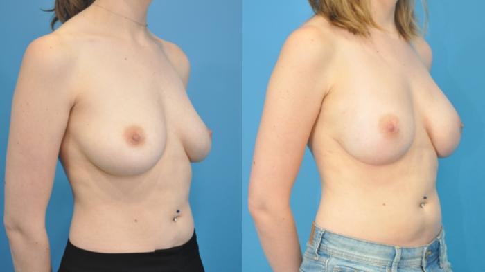 Before & After Breast Reconstruction with Implants Case 356 Right Oblique View in North Shore, IL