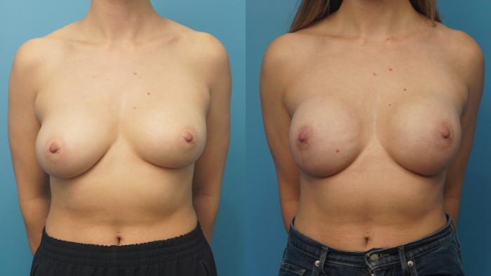 Before & After Breast Reconstruction with Implants Case 367 Front View in North Shore, IL