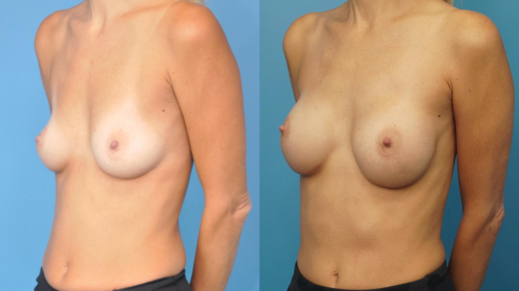 Before & After Breast Reconstruction with Implants Case 376 Left Oblique View in North Shore, IL