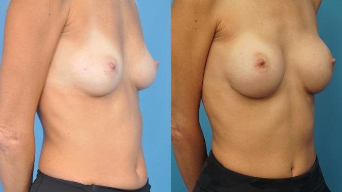 Before & After Breast Reconstruction with Implants Case 376 Right Oblique View in North Shore, IL