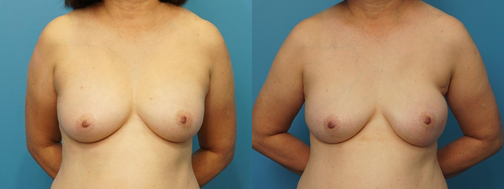 Before & After Breast Reconstruction with Implants Case 380 Front View in North Shore, IL