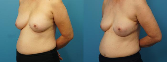 Before & After Breast Reconstruction with Implants Case 380 Left Oblique View in North Shore, IL