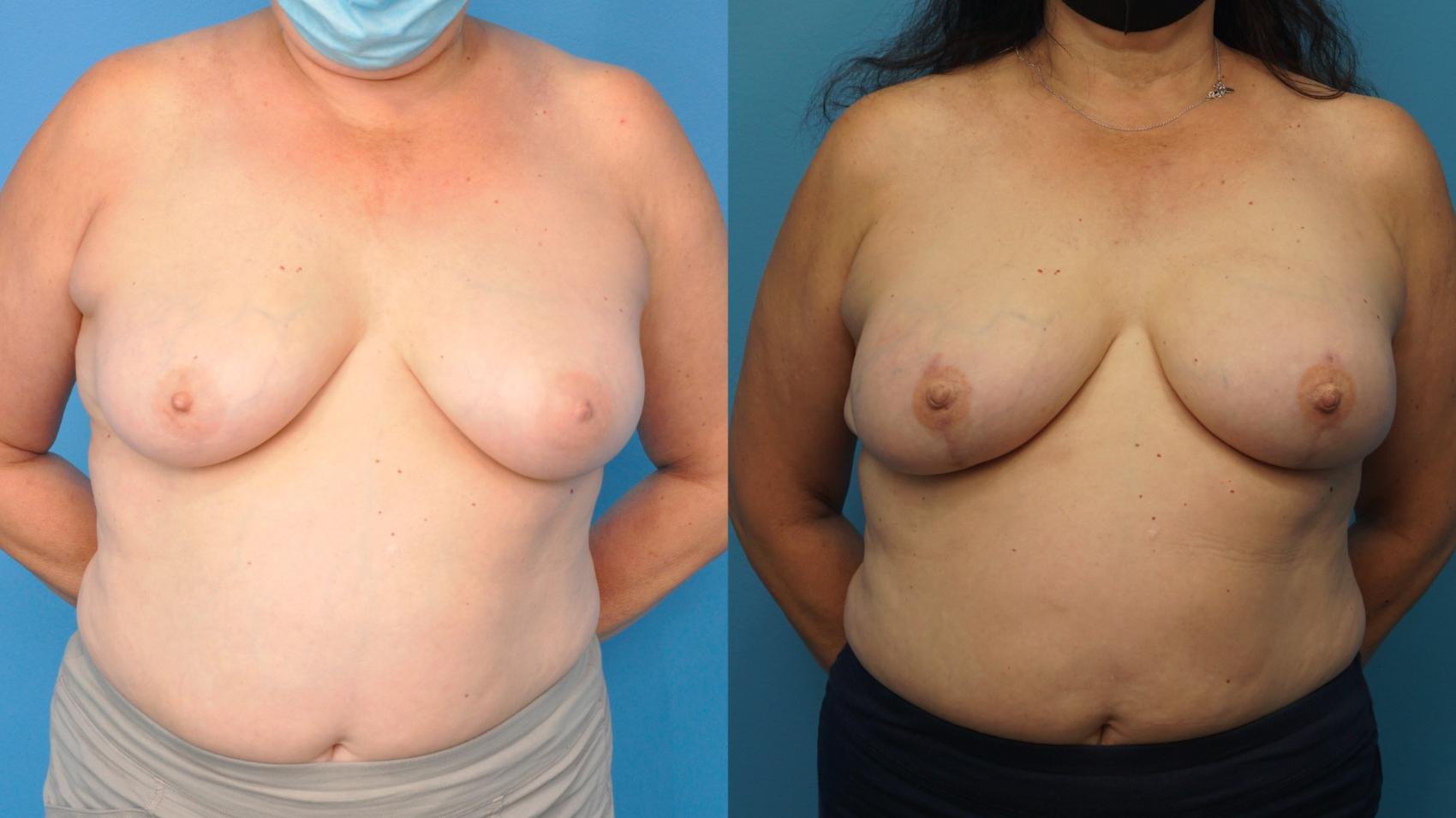 Before & After Breast Reconstruction with Implants Case 381 Front View in North Shore, IL