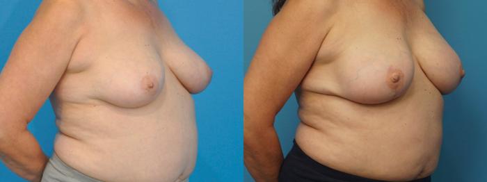 Before & After Breast Reconstruction with Implants Case 381 Right Oblique View in North Shore, IL