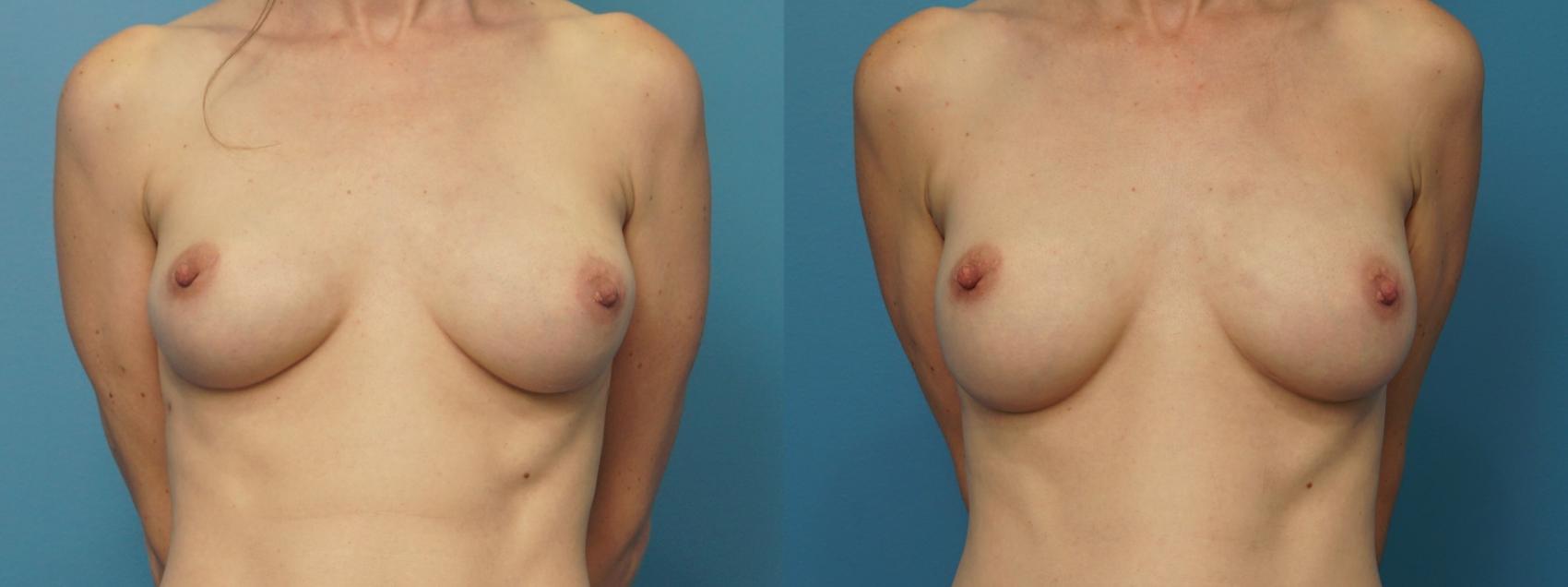 Before & After Breast Reconstruction with Implants Case 383 Front View in North Shore, IL