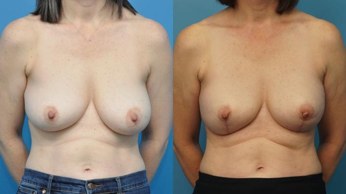 Before & After Breast Reconstruction with Implants Case 388 Front View in North Shore, IL