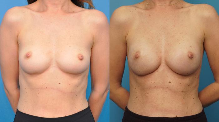 Before & After Breast Reconstruction with Implants Case 389 Front View in North Shore, IL