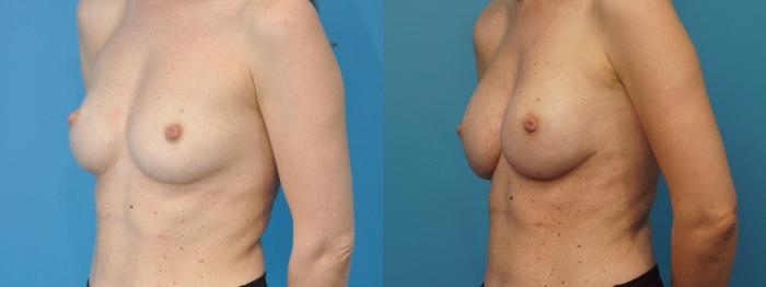 Before & After Breast Reconstruction with Implants Case 389 Left Oblique View in North Shore, IL