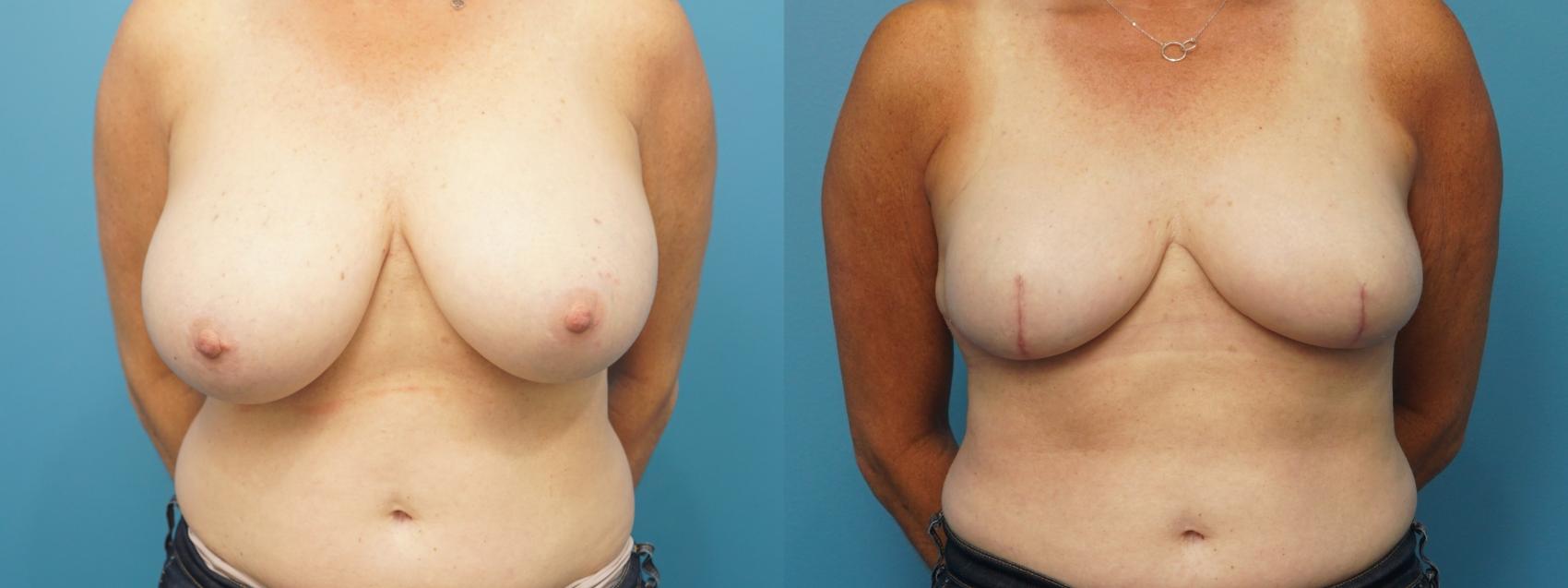 Before & After Breast Reconstruction with Implants Case 391 Front View in North Shore, IL