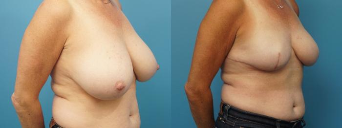 Before & After Breast Reconstruction with Implants Case 391 Right Oblique View in North Shore, IL