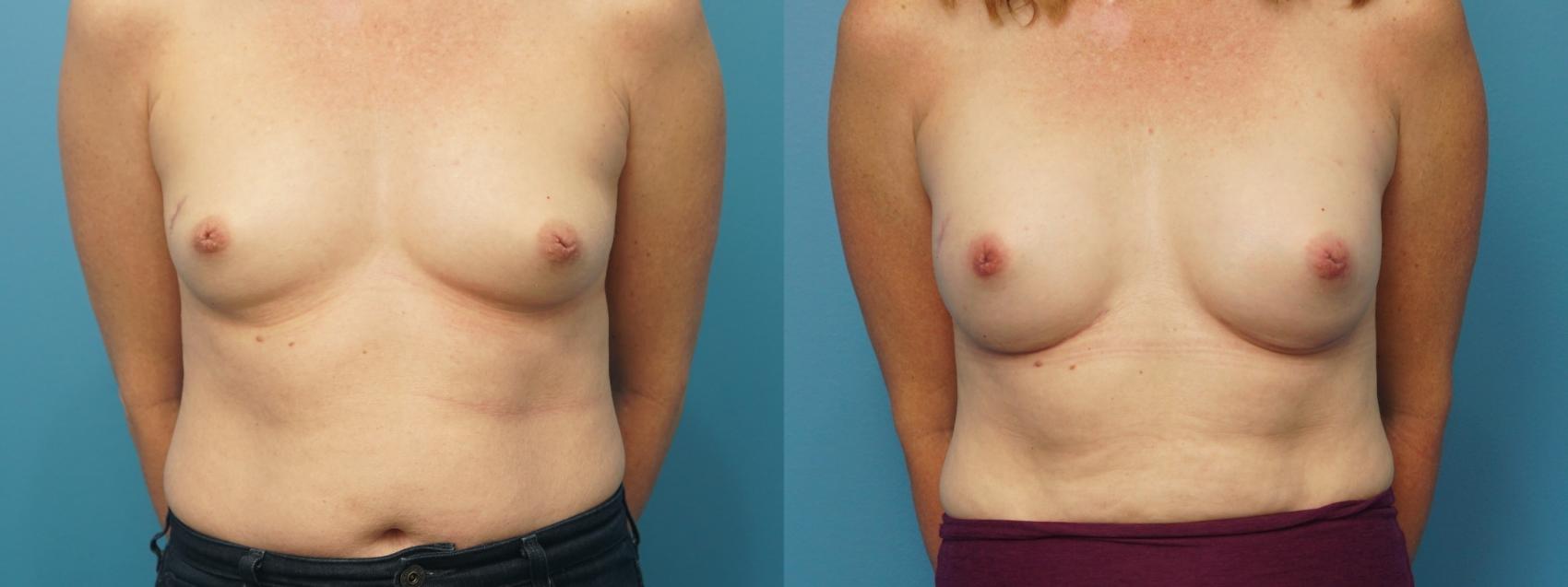 Before & After Breast Reconstruction with Implants Case 392 Front View in North Shore, IL