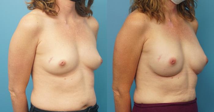 Before & After Breast Reconstruction with Implants Case 392 Right Oblique View in North Shore, IL