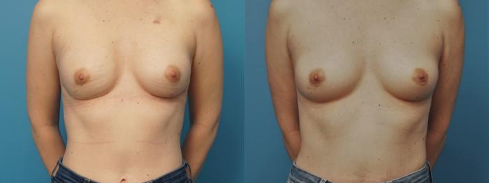Before & After Breast Reconstruction with Implants Case 393 Front View in Northbrook, IL