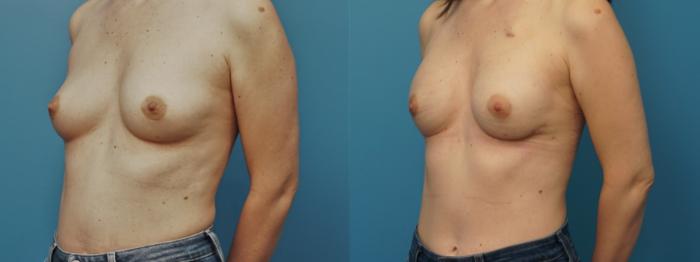 Before & After Breast Reconstruction with Implants Case 393 Left Oblique View in Northbrook, IL