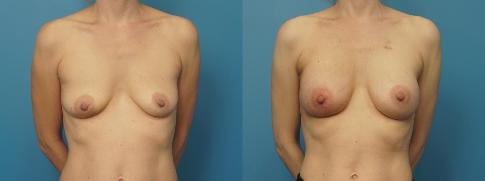 Before & After Breast Reconstruction Case 408 Front View in North Shore, IL