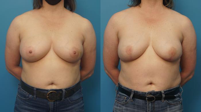 Before & After Breast Reconstruction with Implants Case 410 Front View in North Shore, IL
