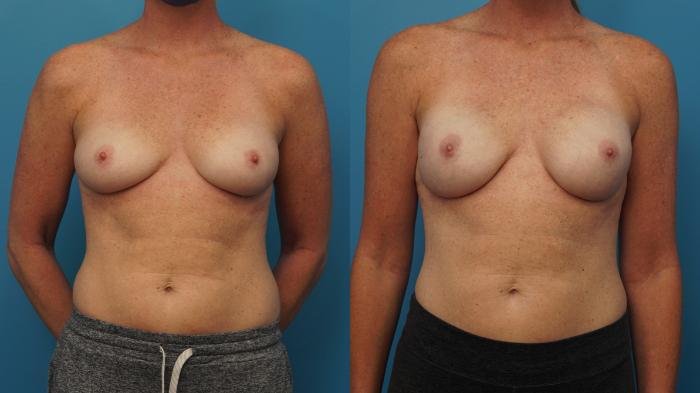 Before & After Breast Reconstruction with Implants Case 412 Front View in Northbrook, IL