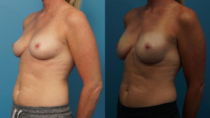 Before & After Breast Reconstruction with Implants Case 412 Left Oblique View in North Shore, IL