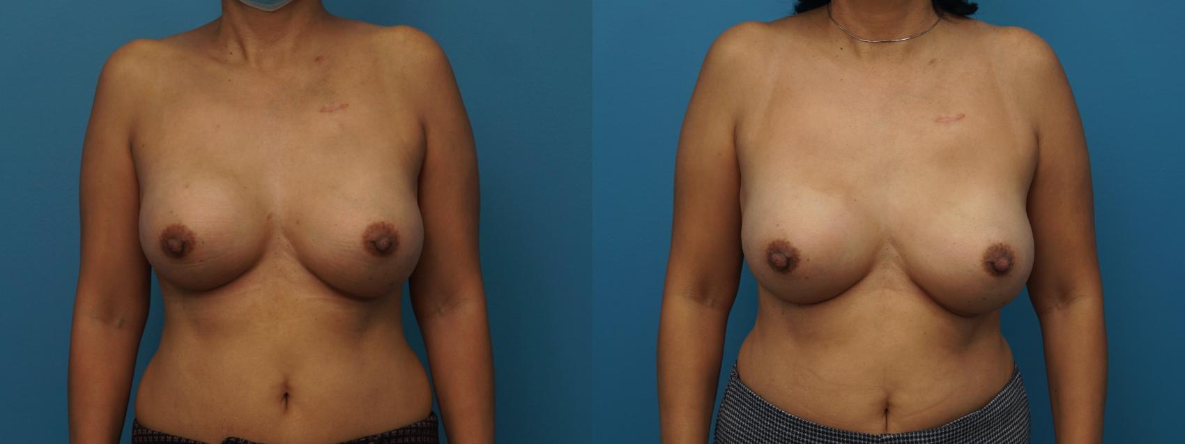 Before & After Breast Reconstruction with Implants Case 414 Front View in North Shore, IL