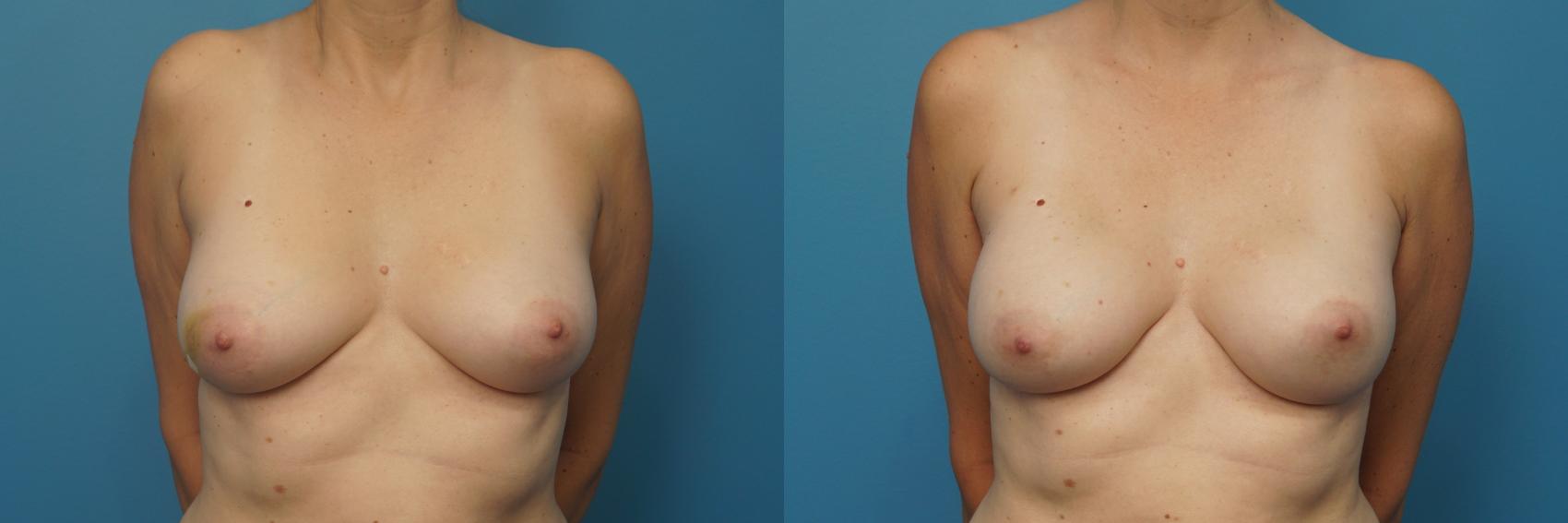 Before & After Breast Reconstruction with Implants Case 415 Front View in North Shore, IL