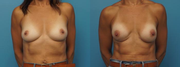 Before & After Breast Reconstruction Case 423 Front View in North Shore, IL