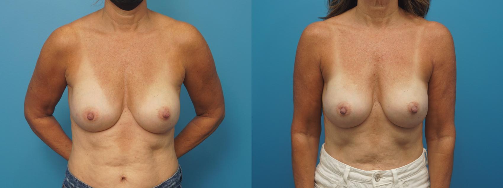 Before & After Breast Reconstruction with Implants Case 424 Front View in North Shore, IL