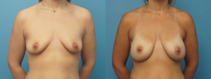 Before & After Breast Reconstruction with Implants Case 446 Front View in North Shore, IL